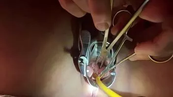 Play Tenaculum grasping cervix for catheter
